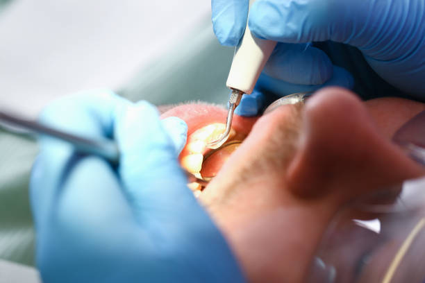 Best Emergency Wisdom Tooth Extraction in Nevada, TX